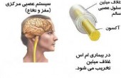 هزینه درمان بیماران ام.اس چقدر است؟