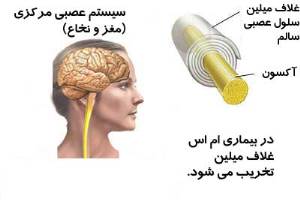 هزینه درمان بیماران ام.اس چقدر است؟