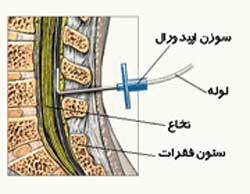 زایمان طبیعی بدون درد چیست؟