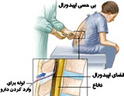 زایمان طبیعی بدون درد چیست؟