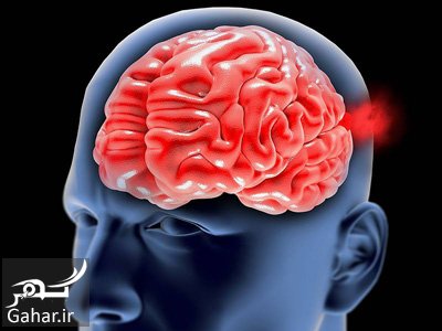 علل و روش های درمان آنوریسم مغزی
