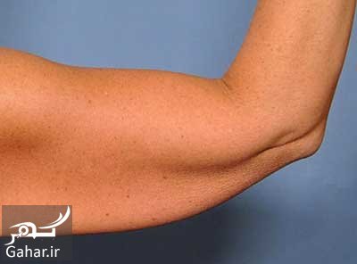 افتادگی پوست بعد از کاهش وزن به چه دلیل است؟