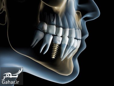 روش انجام ایمپلنت دندان چگونه است؟
