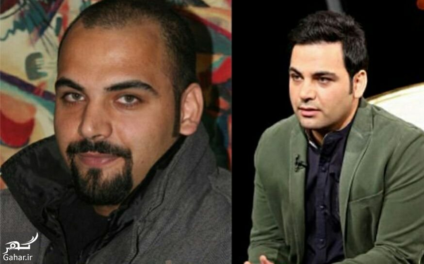عکس احسان علیخانی قبل از کاشت مو