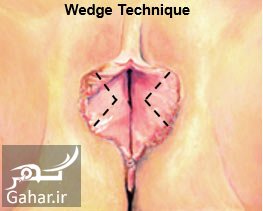هزینه عمل لابیاپلاستی