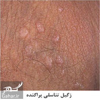 هزینه واکسن HPV چقدر است ؟ واکسن hpv چیست؟