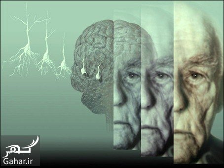 راه های پیشگیری و درمان آلزایمر
