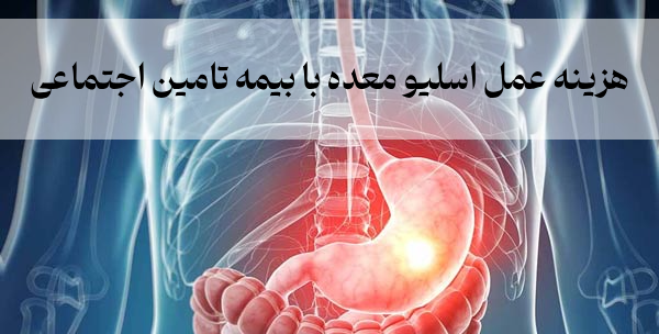 هزینه عمل اسلیو معده با بیمه تامین اجتماعی