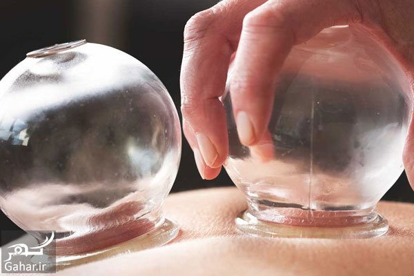 تاثیر بادکش درمانی چگونه است؟