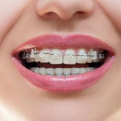 ارتودنسی چیست ؟ + پرسش و پاسخ های مهم