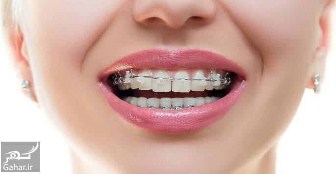 ارتودنسی چیست ؟ + پرسش و پاسخ های مهم