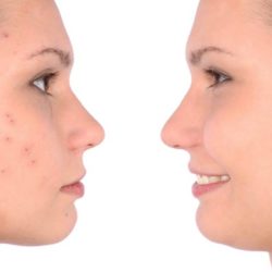 روش های ساده برای از بین بردن جوش و آکنه + روش های جلوگیری از جوش