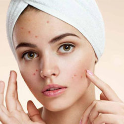جلوگیری از جوش زدن با این روش ها