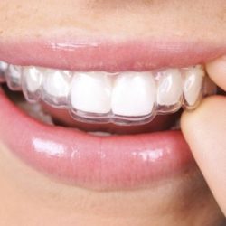 ارتودنسی نامرئی چیست؟ مزایا و معایب آن