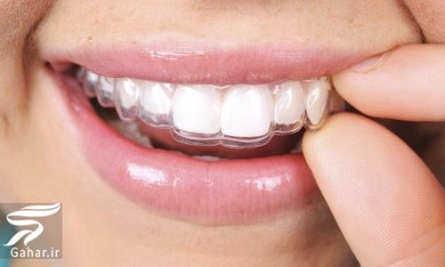 ارتودنسی نامرئی چیست؟ مزایا و معایب آن