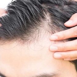 روش های موثر برای رشد دوباره موهای ریخته شده