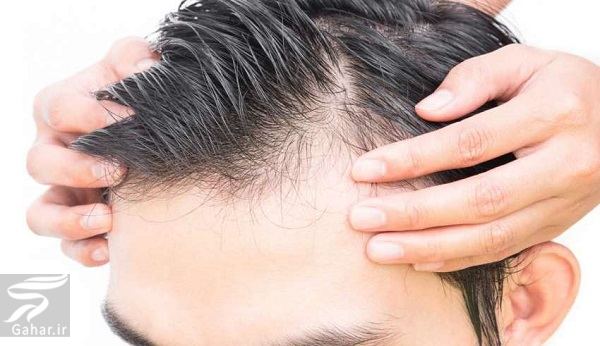 روش های موثر برای رشد دوباره موهای ریخته شده