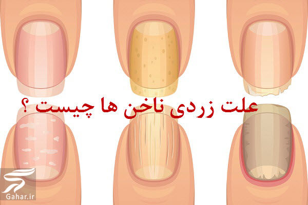 علت زردی ناخن ها و روش های درمان خانگی آن
