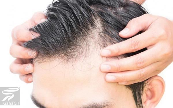 علت چرب شدن موی سر و روش های بر طرف کردن آن