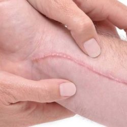 انواع زخم + روش های خانگی از بین بردن جای زخم