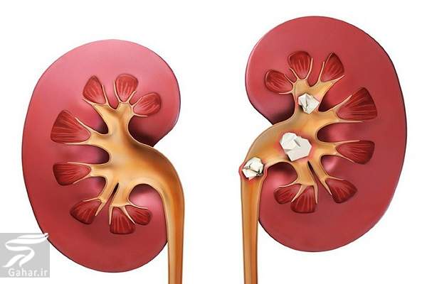 روشهای رژیمی و غذایی برای جلوگیری از سنگ کلیه