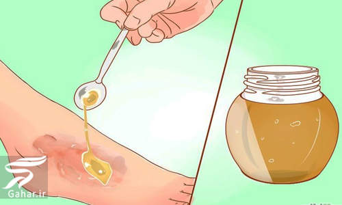تاثیر استفاده از عسل برای بهبود زخم