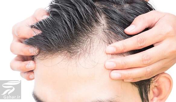 داروهایی که باعث ریزش مو می شوند