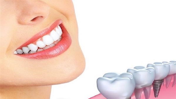 ایمپلنت کامل فک بالا و پایین چگونه انجام میشود؟