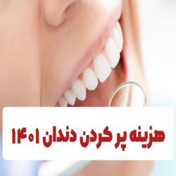 هزینه پر كردن دندان ۱۴۰۱ (جدول کامل هزینه ها)