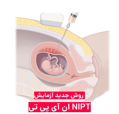 روش جدید آزمایش nipt &ndash; ان آی پی تی