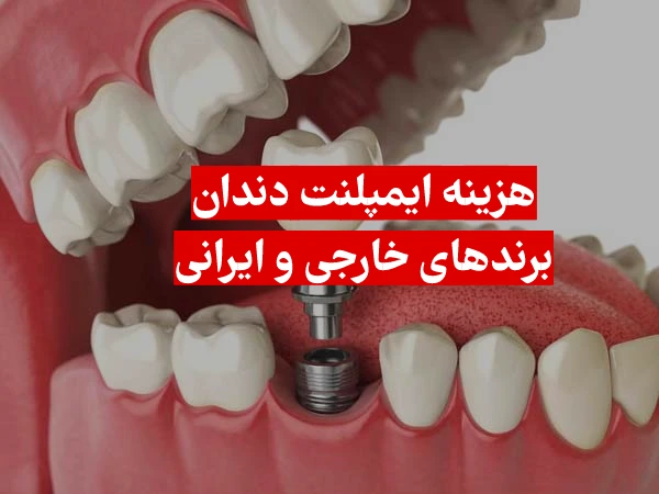 هزینه ایمپلنت دندان سال ۱۴۰۲ با بیمه و بدون بیمه