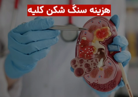 هزینه سنگ شکن کلیه 1403