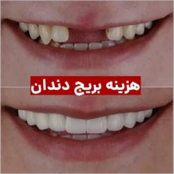 هزینه بریج دندان ۱۴۰۳ + مزایا و معایب بریج دندان