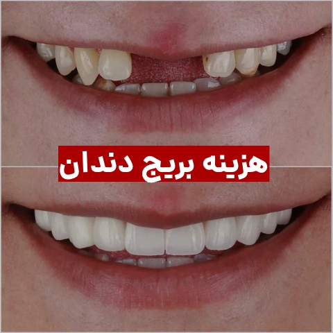 هزینه بریج دندان ۱۴۰۳ + مزایا و معایب بریج دندان