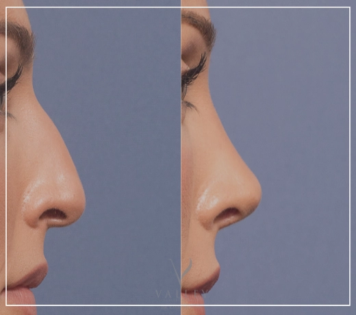 هزینه عمل بینی ۱۴۰۲ چقدر است؟ (بینی استخوانی و بینی گوشتی)