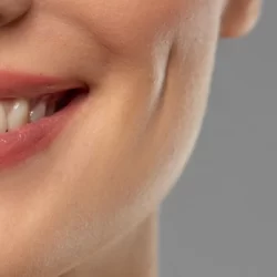 هزینه عمل چال گونه ۱۴۰۳ + جزییات و ماندگاری چال خنده