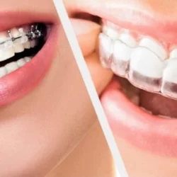 هزینه ارتودنسی با بیمه تامین اجتماعی
