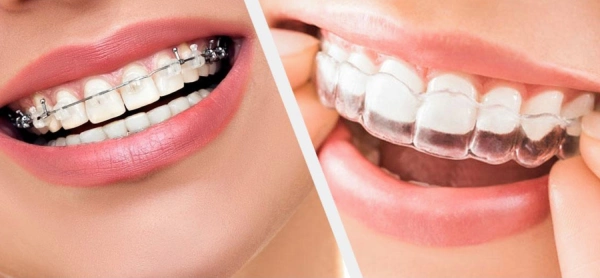 هزینه ارتودنسی با بیمه تامین اجتماعی