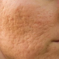 سابسیژن بهتر است یا لیزر؛ کدام روش مناسب تر است؟