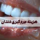 هزینه جرم گیری دندان ۱۴۰۵ + هزینه با بیمه و مزایای جرمگیری دندان