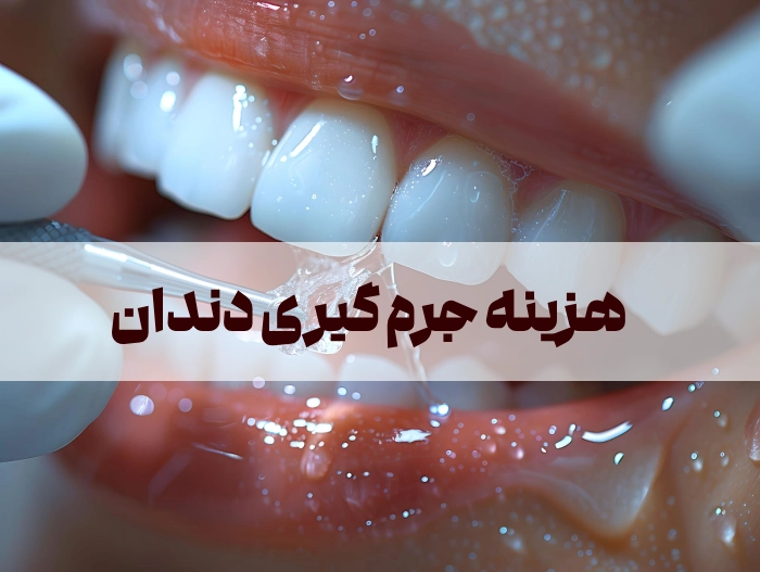 هزینه جرم گیری دندان ۱۴۰۵ + هزینه با بیمه و مزایای جرمگیری دندان