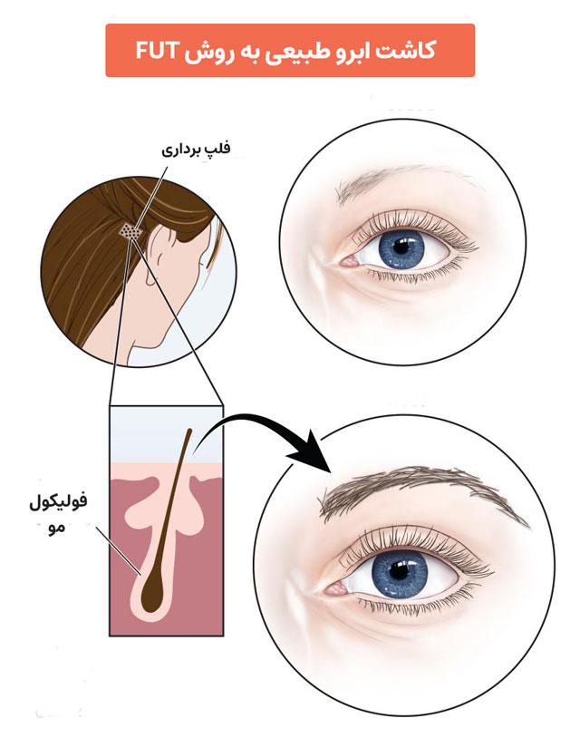بررسی کاشت ابرو به روش fit + معرفی بهترین کلینیک