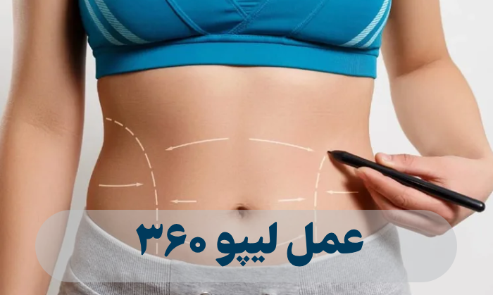 عمل لیپو ۳۶۰ + دوره نقاهت، عوارض و هزینه عمل لیپو