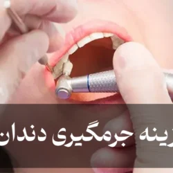 هزینه جرمگیری دندان + قیمت پولیش و بروساژ دندان