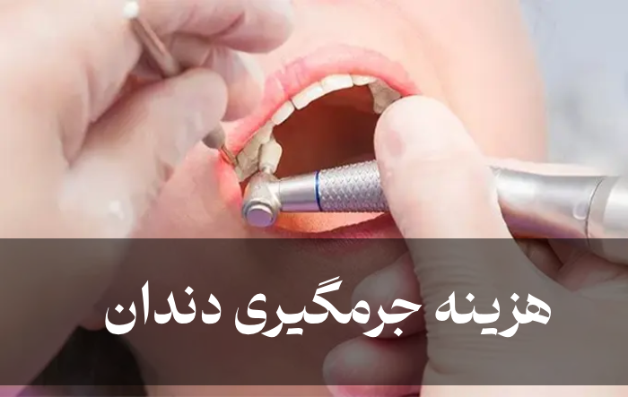 هزینه جرمگیری دندان + قیمت پولیش و بروساژ دندان