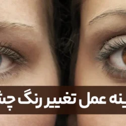 هزینه عمل تغییر رنگ چشم + دوران نقاهت و عوارض