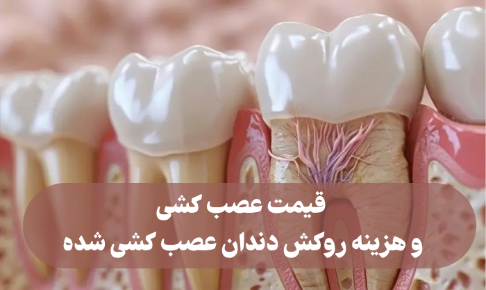 قیمت عصب کشی و هزینه روکش دندان عصب کشی شده