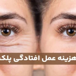 هزینه عمل افتادگی پلک + عوارض احتمالی