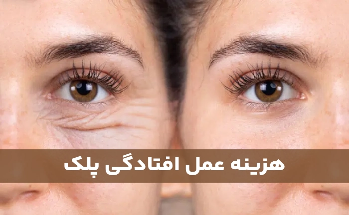 هزینه عمل افتادگی پلک + عوارض احتمالی