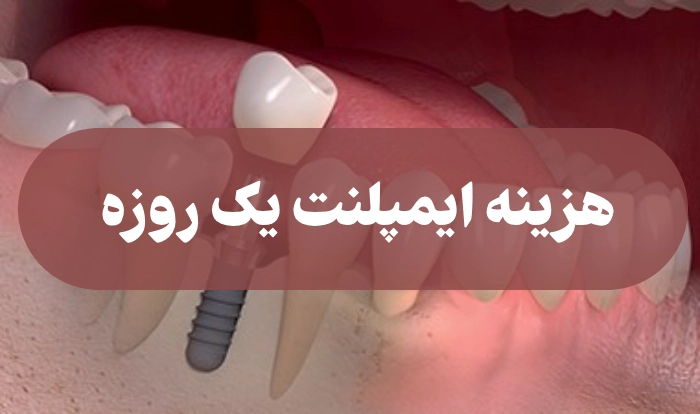 هزینه ایمپلنت یک روزه + نکاتی درباره ایمپلنت فوری